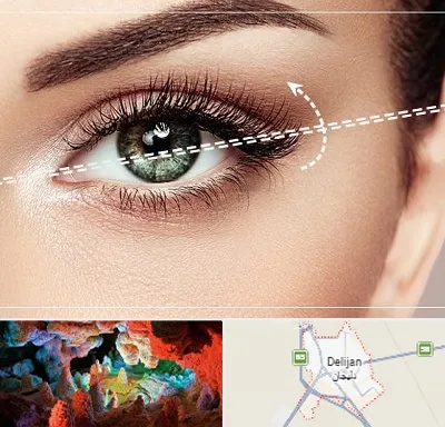 جراحی چشم گربه ای در دلیجان