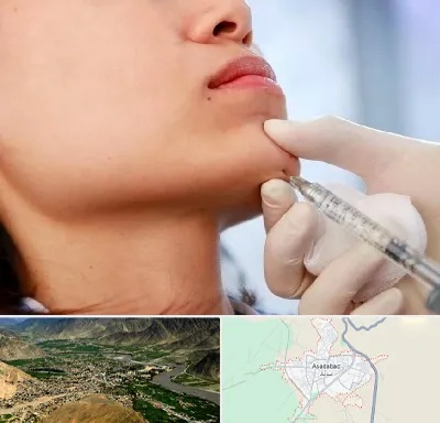 زاویه سازی صورت در اسدآباد