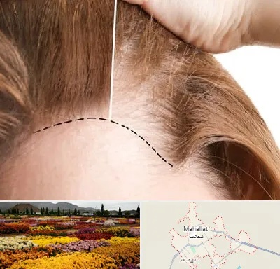 کاشت مو برای خانمها در محلات