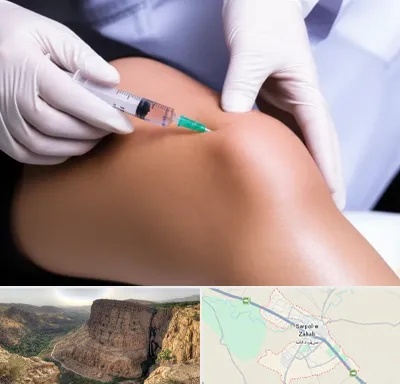 پلاسما درمانی PRP در سرپل ذهاب