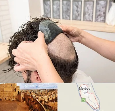پروتز مو در میبد