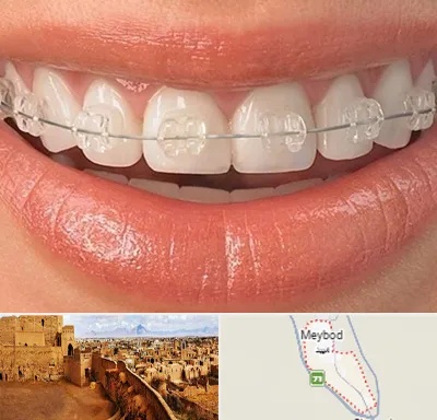 ارتودنسی اقساطی در میبد