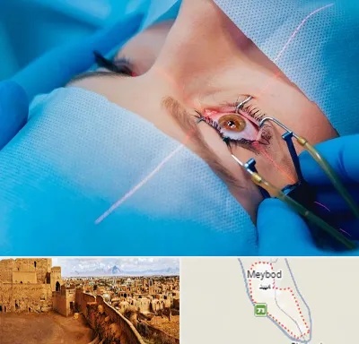 عمل prk چشم در میبد