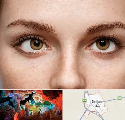 متخصص انحراف چشم در دلیجان