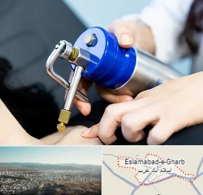 کرایوتراپی در اسلام آباد غرب