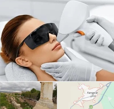 مرکز لیزر مو در کنگاور