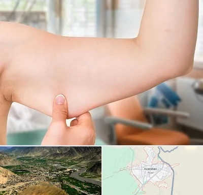 براکیوپلاستی در اسدآباد
