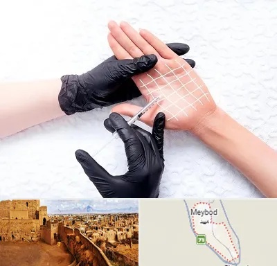 تزریق بوتاکس کف دست در میبد