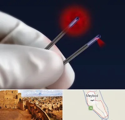 جراحی سینه با لیزر در میبد