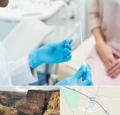 دکتر زگیل تناسلی HPV در سرپل ذهاب