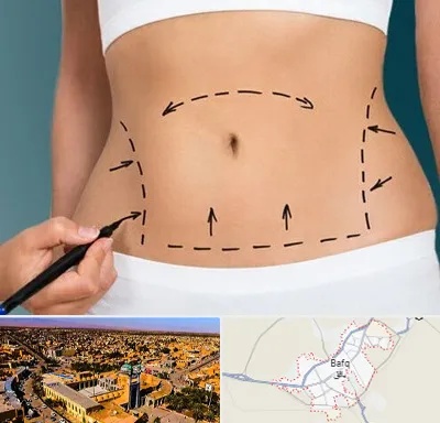 عمل ابدومینوپلاستی در بافق