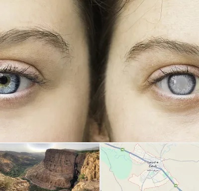 متخصص آب سیاه (گلوکوم) در سرپل ذهاب