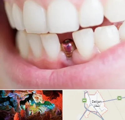 ایمپلنت اقساطی در دلیجان
