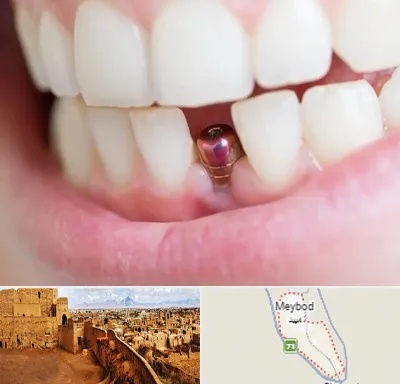ایمپلنت اقساطی در میبد