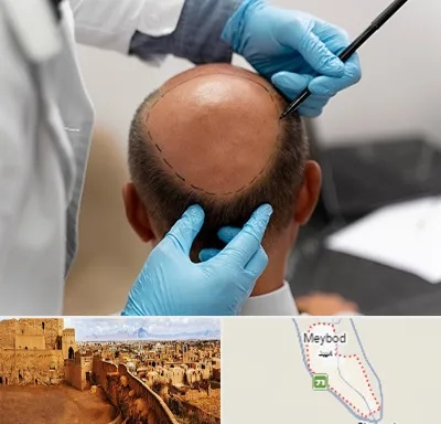 آموزش کاشت مو در میبد