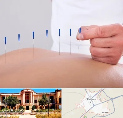 دکتر طب سوزنی در خمین