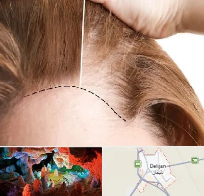 کاشت مو برای خانمها در دلیجان