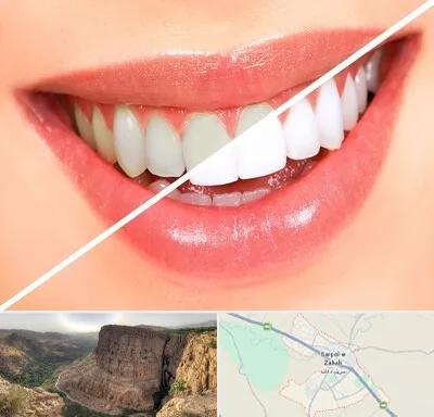 بلیچینگ دندان در سرپل ذهاب