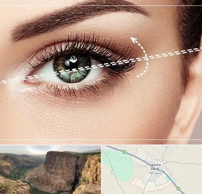 جراحی چشم گربه ای در سرپل ذهاب