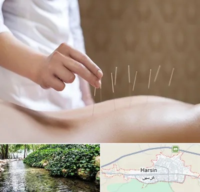 درای نیدلینگ در هرسین