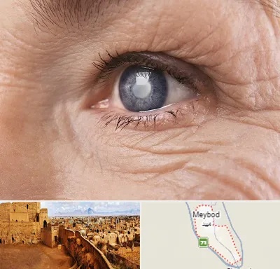 متخصص آب مروارید در میبد