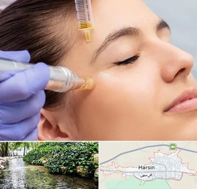 میکرونیدلینگ در هرسین