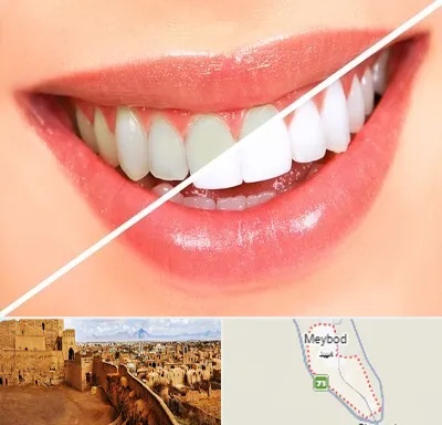 بلیچینگ دندان در میبد