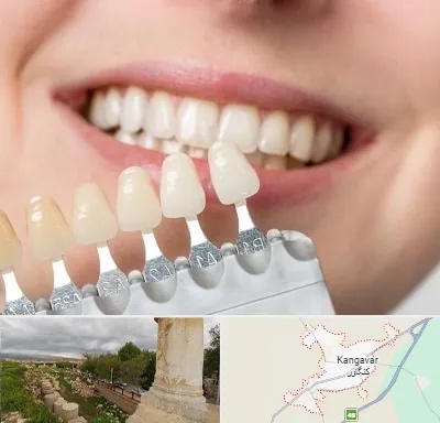 مرکز کامپوزیت دندان در کنگاور
