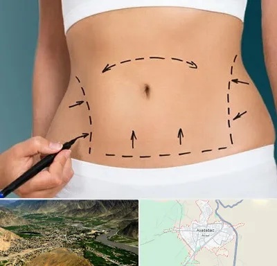 عمل ابدومینوپلاستی در اسدآباد