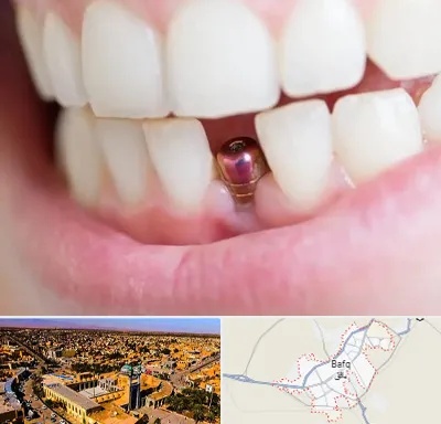 ایمپلنت اقساطی در بافق