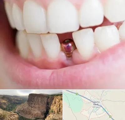 ایمپلنت اقساطی در سرپل ذهاب