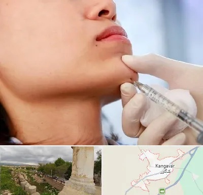 زاویه سازی صورت در کنگاور