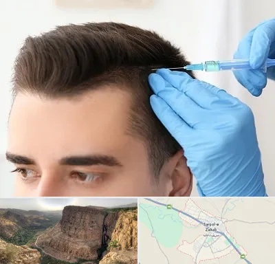 مزوتراپی مو در سرپل ذهاب