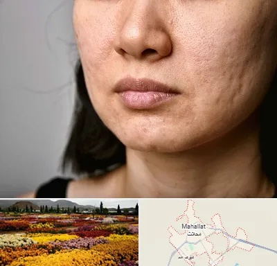 سابسیژن جای جوش در محلات