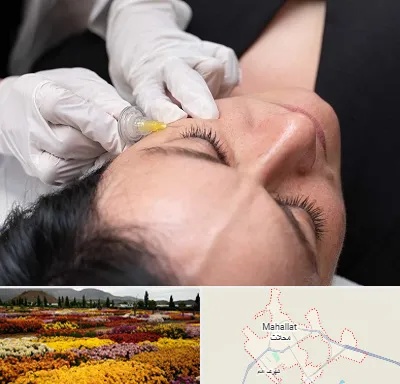 کربوکسی تراپی در محلات