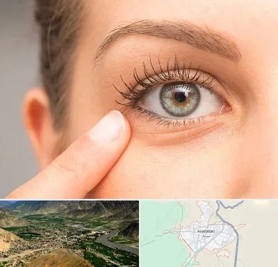 جراح پف چشم در اسدآباد