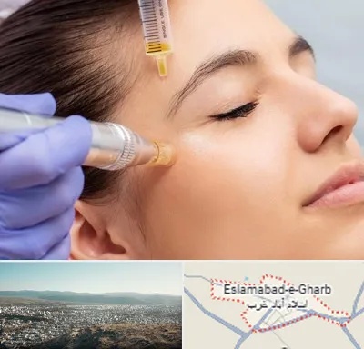 میکرونیدلینگ در اسلام آباد غرب
