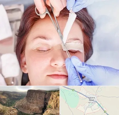 جراحی پلک افتاده در سرپل ذهاب