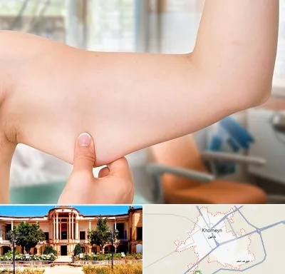 براکیوپلاستی در خمین