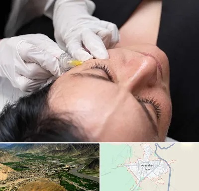 کربوکسی تراپی در اسدآباد