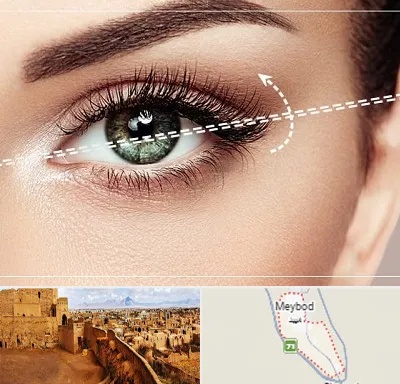 جراحی چشم گربه ای در میبد