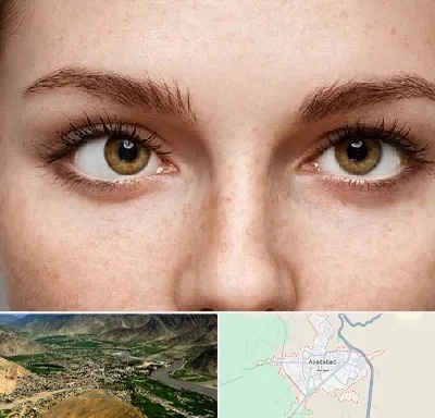 متخصص انحراف چشم در اسدآباد