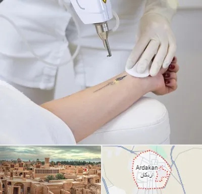 پاک کردن تتو با لیزر در اردکان