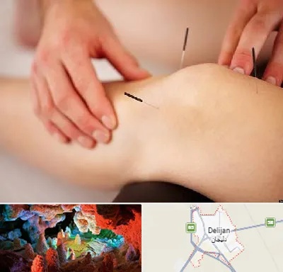 دکتر طب سوزنی برای لاغری در دلیجان