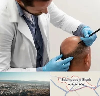 کاشت مو به روش تکثیری در اسلام آباد غرب