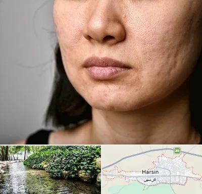 سابسیژن جای جوش در هرسین