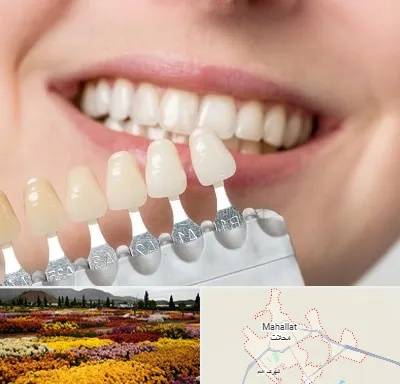 مرکز کامپوزیت دندان در محلات