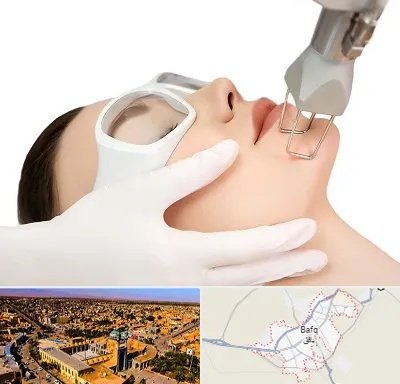لیزر فرکشنال در بافق