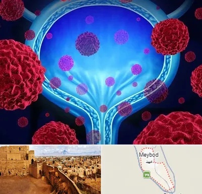 دکتر سرطان مثانه در میبد