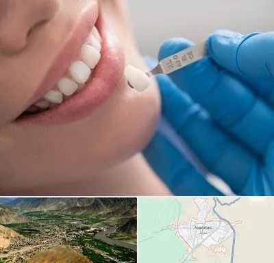 مرکز لمینت دندان در اسدآباد